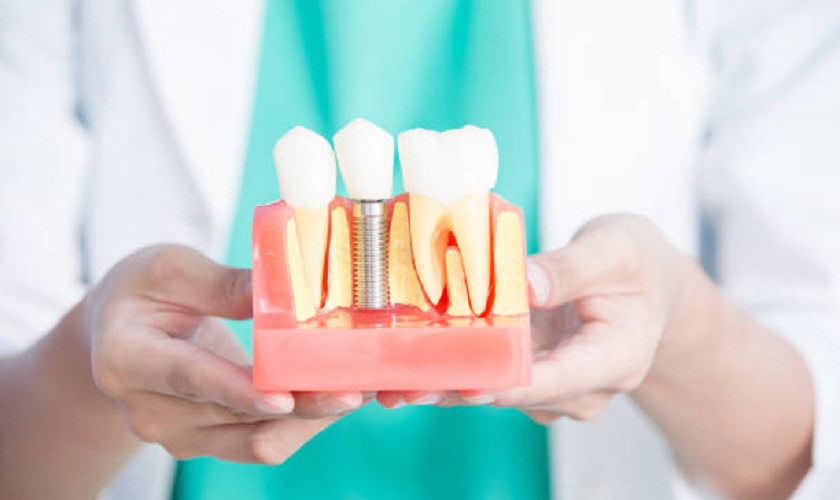 Cần tham vấn về giá làm răng sứ Implant tức thì và quy trình thực hiện