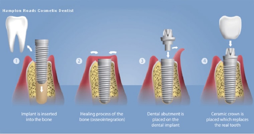Quy trình làm răng sứ implant tức thì